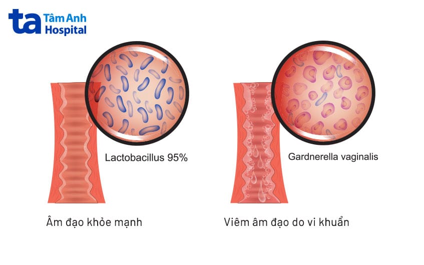 Nguồn hình ảnh: Bệnh viện Tâm Anh