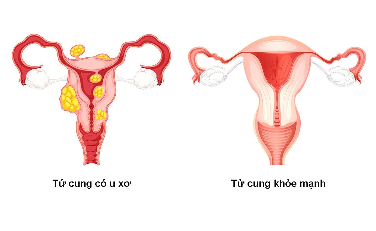 Trong một số trường hợp, máu kinh vón cục nhiều và kéo dài trong ngày "đèn đỏ" có thể là dấu hiệu của U xơ tử cung