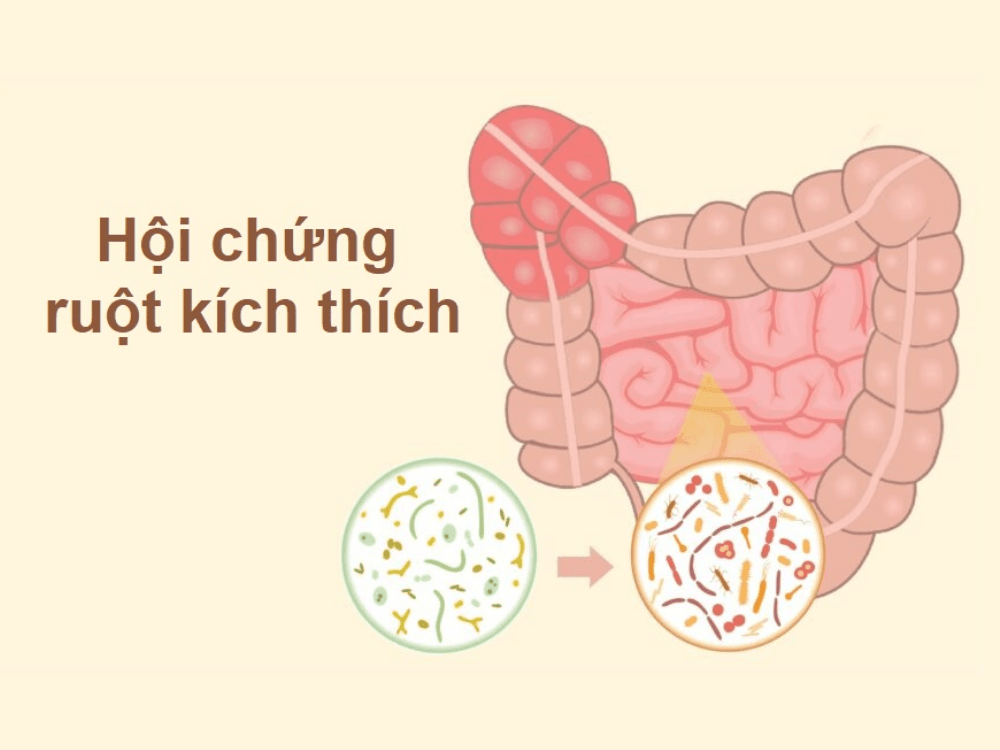 Phụ nữ mắc IBS thường thấy tình trạng tiêu chảy hoặc táo bón nặng hơn trong kỳ kinh nguyệt, do hormone thay đổi