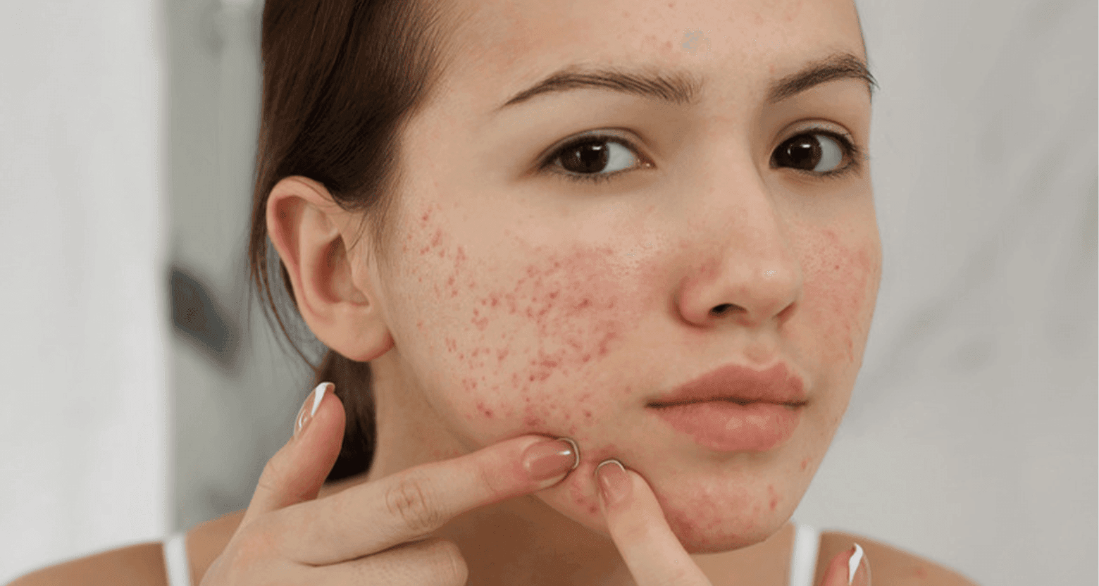 Mụn đầu đen, mụn đầu trắng, mụn viêm xuất hiện nhiều hơn ở độ tuổi dậy thì