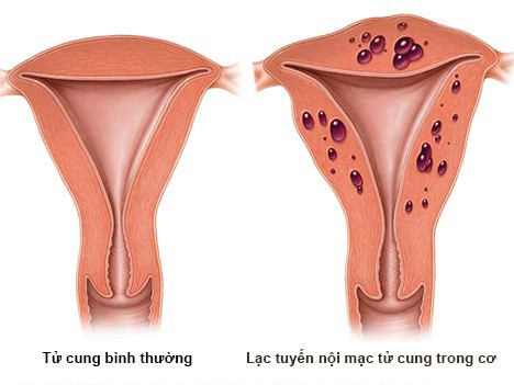Bệnh phụ khoa: Lạc tuyến nội mạc tử cung